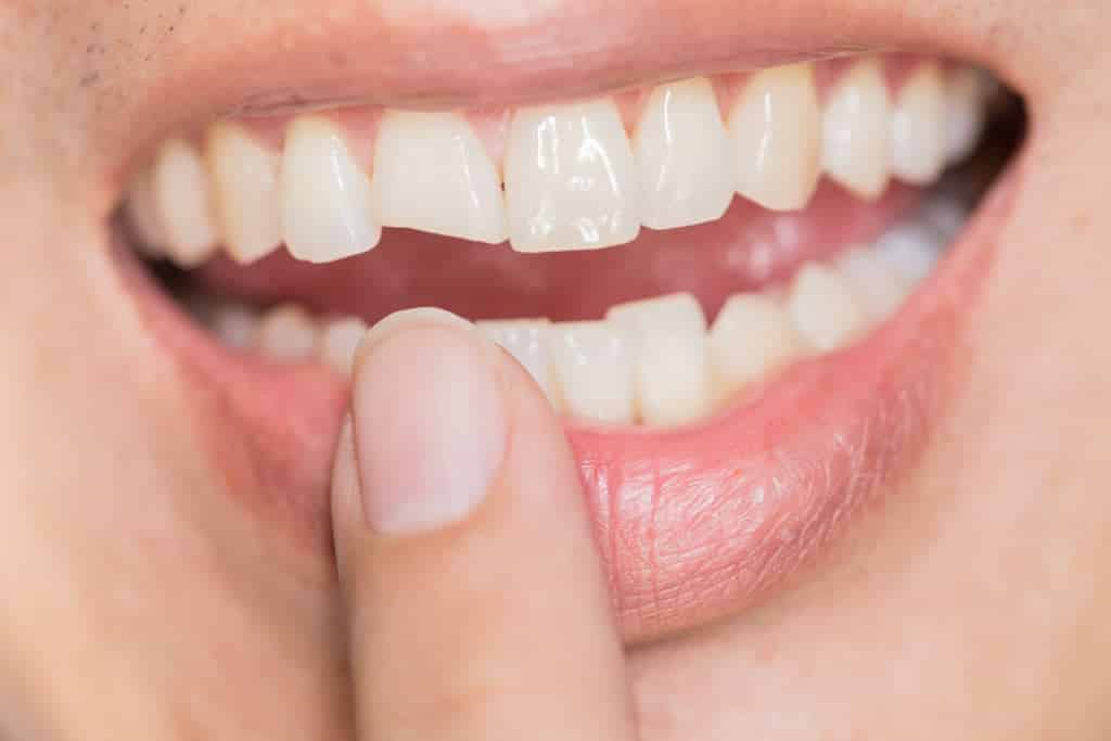 chipped baby tooth uk
